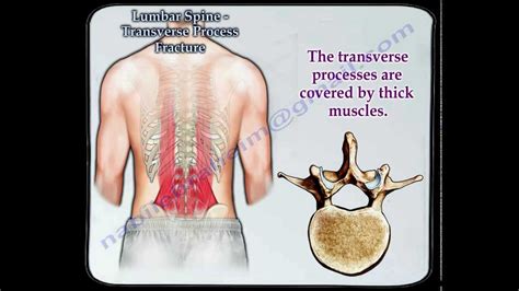 Lumbar Spine Transverse Process Fracture Everything You Need To Know