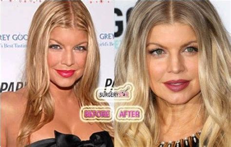 Has Fergie Got Plastic Surgery Before After Pictures