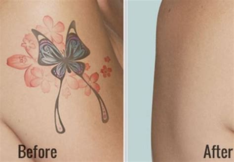 If you have faint eyebrows, no eyebrows, or partial eyebrows, a cosmetic tattoo can help. 7 best Dermabrasion Tattoo Removal images on Pinterest | Laser tattoo, Tattoo removal and Best ...