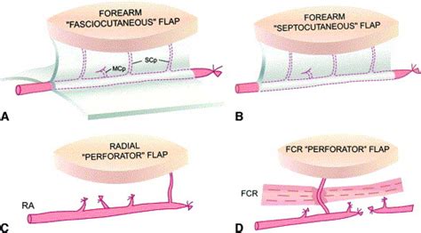 New Nomenclature Concept Of Perforator Flap British Journal Of