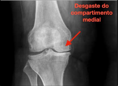 Desgaste do joelho porque ele ocorre diagnóstico e tratamento