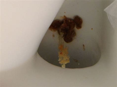 White Mucus Stool Yeast Infection Guide