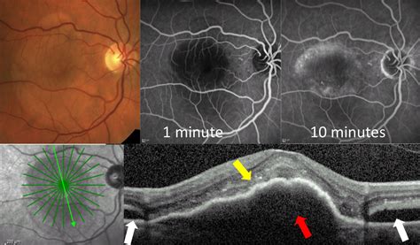 Lesson Understanding Amd Presentations And Prognoses