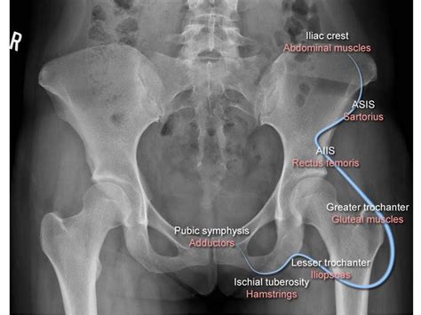 Anterior Inferior Iliac Spine Avulsion Aiis Sports Orthobullets Com