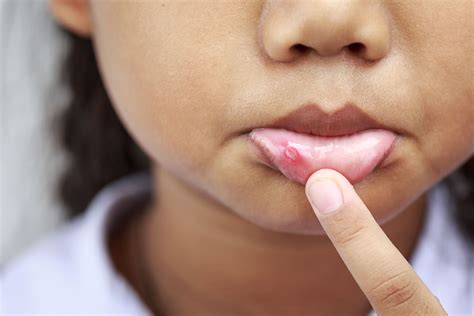 What Are Canker Sores And Can They Be Prevented