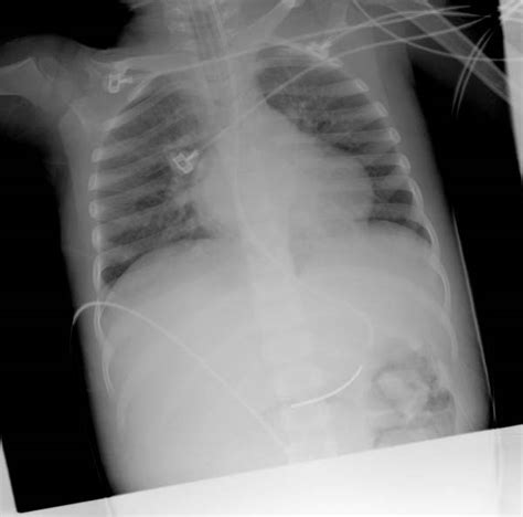 Cardiomegaly Chest X Ray Wikidoc
