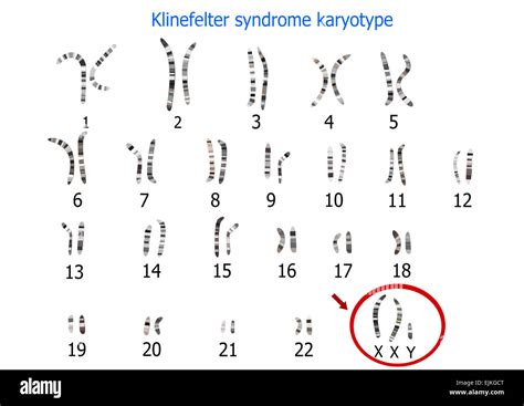 Le Syndrome De Klinefelter Caryotype Photo Stock Alamy