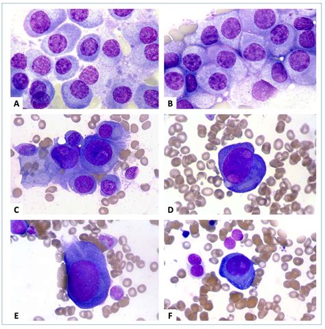 Images From The Haematologica Atlas Of Hematologic Cytology Plasma