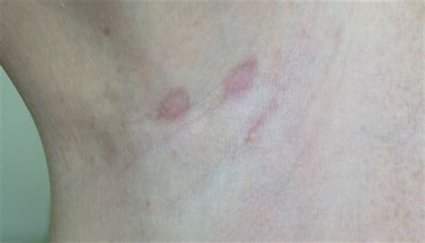 Maybe you would like to learn more about one of these? Derm Dx: Itchy rash in the groin, axilla - Clinical Advisor