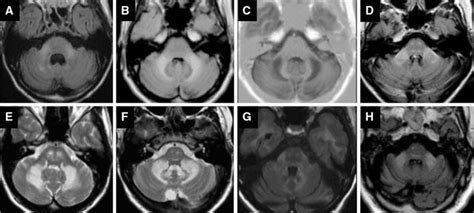 Cerebral Mri Illustrating Middle Cerebellar Peduncles Involvement