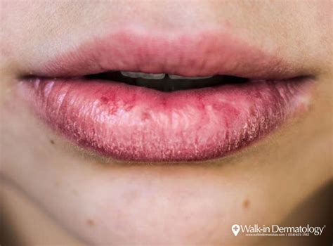 Severely Dry Lips Treatment Lipstutorial Org