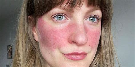 Beauty Influencer With Rosacea Had Photo Removed From Instagram