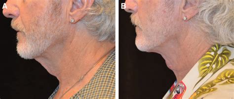 The Single Incision Minimally Invasive Simi Neck Lift Abstract