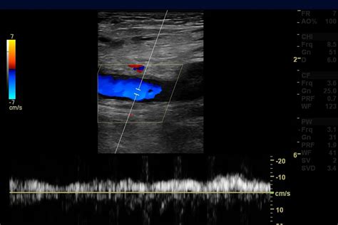 Venous Duplex Ultrasound Test In Naples Fl Naples Cardiac