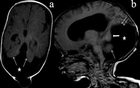 Dandy Walker Malformation T1w Axiala And Sagittal B Image Of Brain