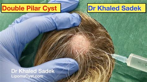 Massive Pilar Cysts Removed Dr Khaled Sadek LipomaCyst Com Pimple