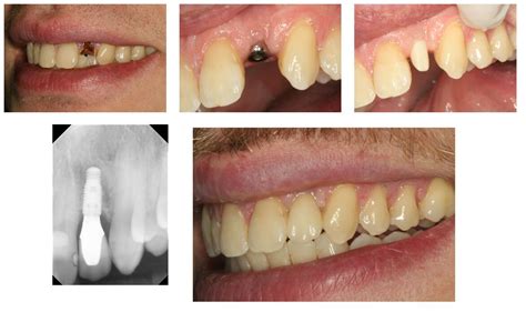 Dental Implants The Best Way To Replace A Single Tooth