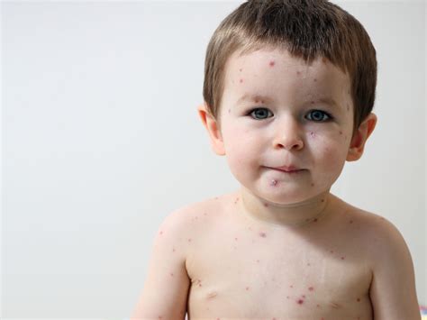 Come Curare La Malattia Mano Piede Bocca Nei Bambini Amico Pediatra
