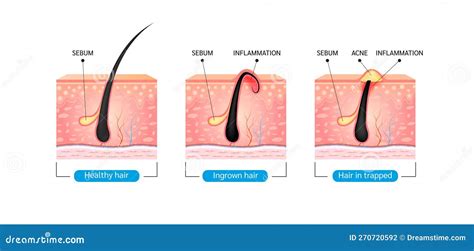 Ingrown Hair Hair Has Grown Back Into The Skin Surface After Shaving