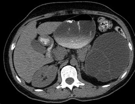 Multilocular Cystic Nephroma A Systematic Literature Review Of The