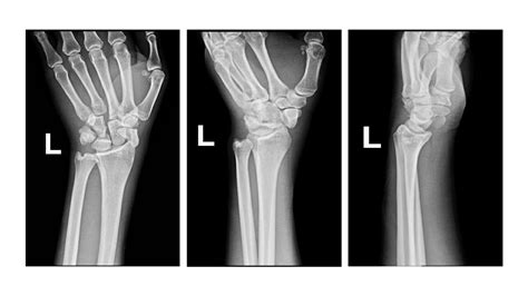 Traumatic Complex Scaphoid Dislocation With Radial Carpal Disruption A