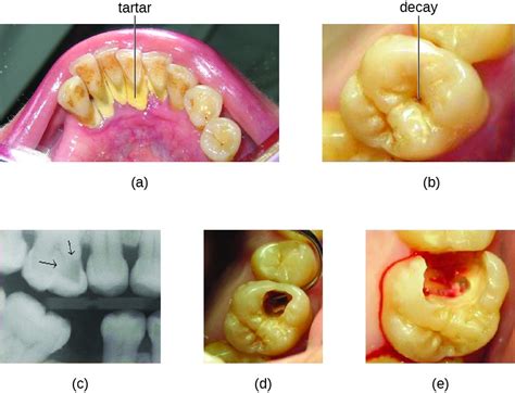 Microbial Diseases Of The Oral Cavity Microbiology