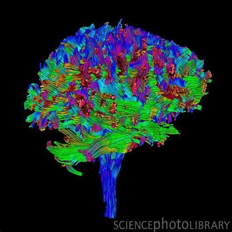 Coloured 3d Diffusion Tensor Imaging Dti Scan Of The Brain Showing