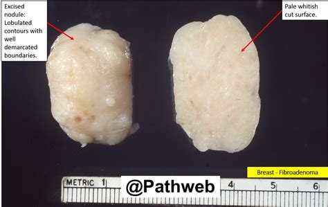 Breast Fibroadenoma Nus Pathweb Nus Pathweb