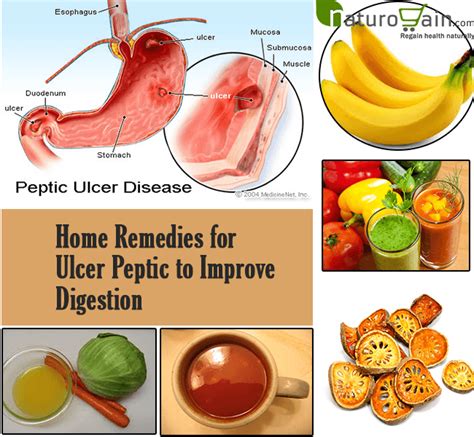 Homemade Treatment For Gastric Ulcer Homemade Ftempo