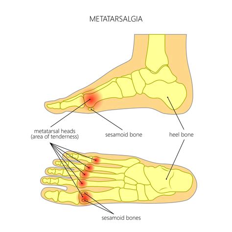 Metatarsalgia — Haag Foot And Ankle
