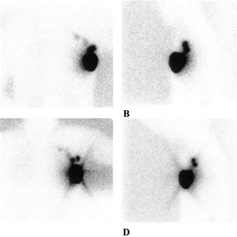 Static Lymphoscintigraphy Image Obtained 3 Hours Postinjection Upper