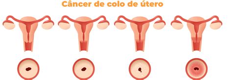 El cáncer endometrial o cuerpo del utero es el tipo más común de cáncer uterino. cancer-colo-utero