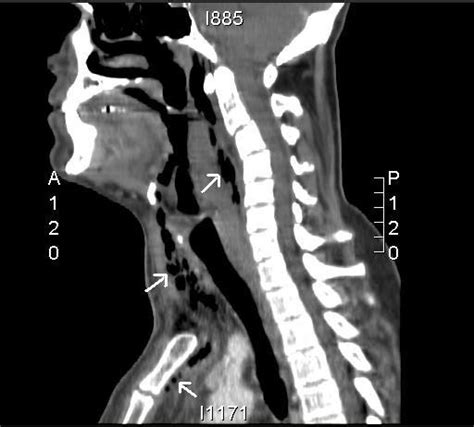 Sagittal Reconstruction Of Ct Of The Neck And Upper Mediastinum