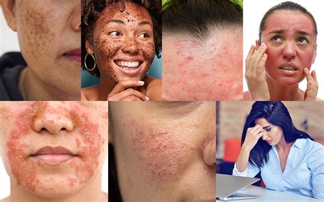 How To Get Rid Of Blotchy Skin Reequil