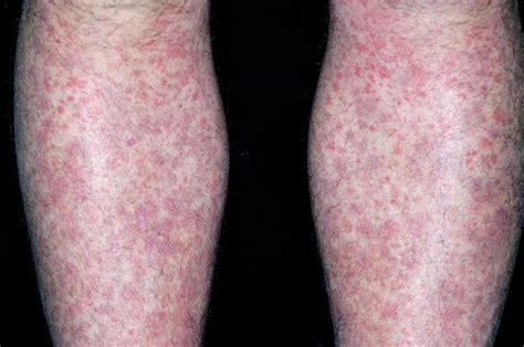 Allergic Purpura On The Legs Photograph By Dr P Marazziscience Photo