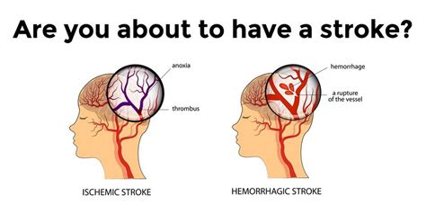 Stroke Symptoms 15 Early Signs And Warning Of Mild Stroke