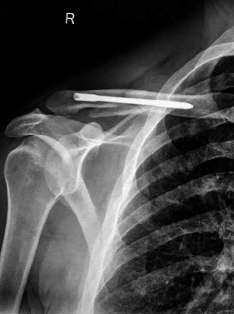Fracture Of Clavicle Collarbone Dr Kish Orthopedic Surgeon