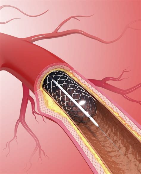 Coronary Angioplasty And Stenting Victoria Heart