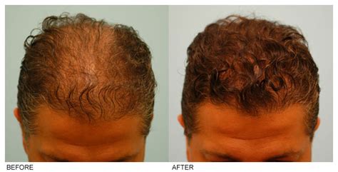 Best Hair Transplant In Denver Co Revive Hair Restoration Sights