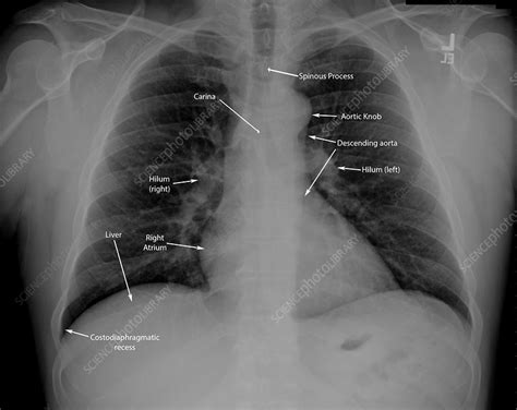 Etiologies of low lung volumes and hyperinflation are also discussed. Normal chest X-ray with labels - Stock Image - C036/6419 ...