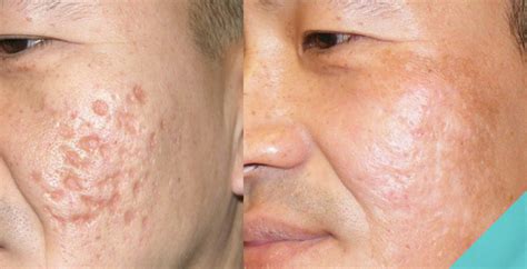 Removing Acne Scars With Revitol Scar Cream Revitol Creams