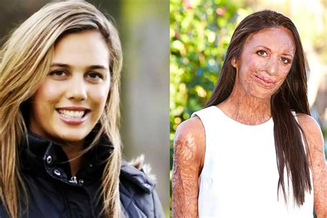 Turia Pitt Didn T Let Burning While Running Stop Her