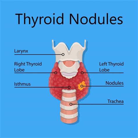 Thyroid Nodules Key Points You Should Know