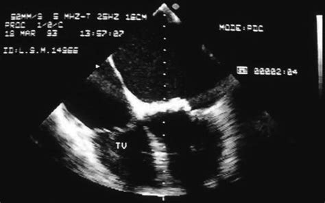 The Rheumatic Tricuspid Valve Thoracic Key