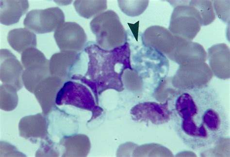 Inclusions Of Lymphocyte Erythrocyte And Neutrophil In Advanced