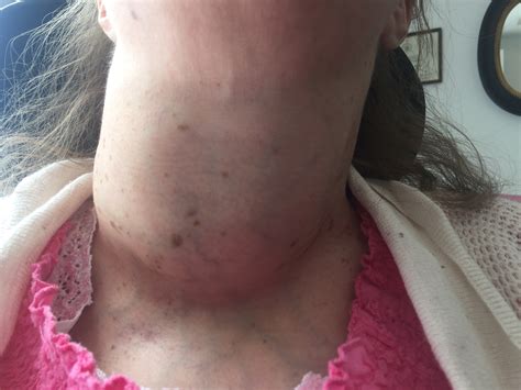 Thyroid Ablation 101 What To Do About A Massive Goiter In A Patient