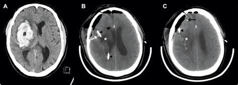 A Preoperative Computed Tomography Ct Scan Of Patient 1 Showing The