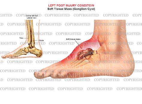 Left Foot Ganglion Cyst — Medical Art Works