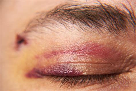 Close View Of A Bruise Near The Eye The Face Of A Man With A Hematoma