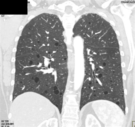 Multiple Lungs Cysts In Tuberous Sclerosis Chest Case Studies